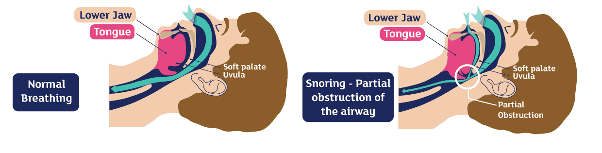 Snoreeze LabFit Oral Device: For loud snoring and obstructive sleep apnoea Snoreeze Snoreeze LabFit Oral Device: For loud snoring and obstructive sleep apnoea Snoreeze